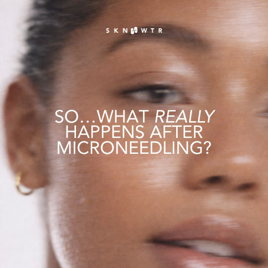 SKN WTR Instagram work Microneedling-Coconut Sundays Creative